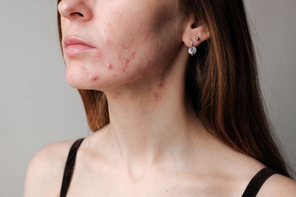 Adult Acne Skin