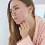 Dermatology Acne Treatment