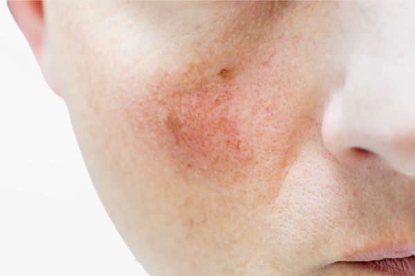 Laser Redness IPL Treatment
