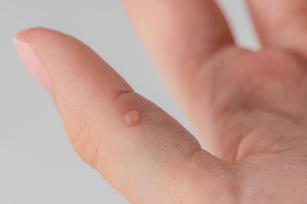 Laser Wart Removal