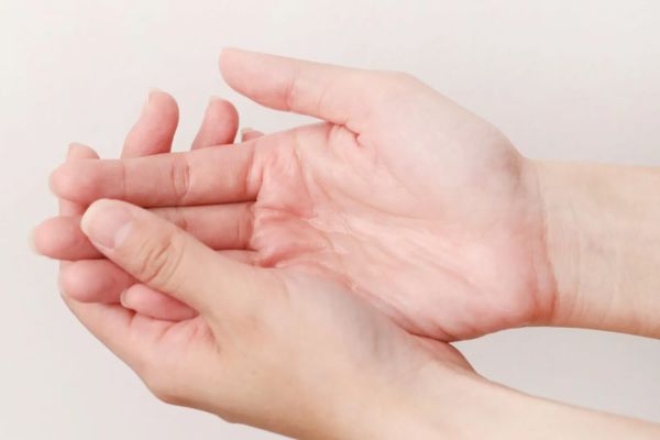 Hands Excessive Sweating