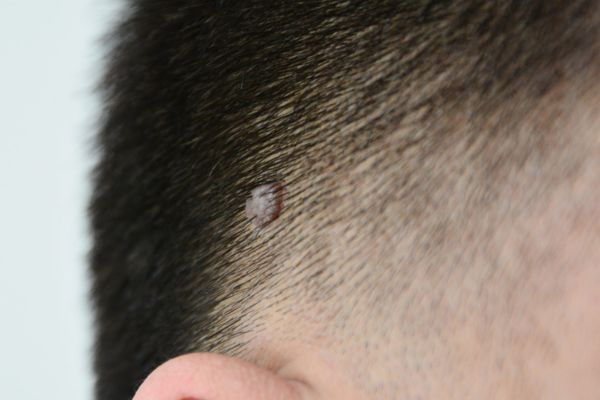 Seborrhoeic Keratosis Removal