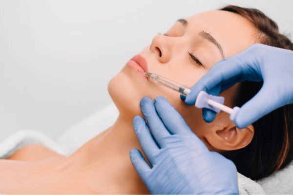 Smokers Line Lip Filler