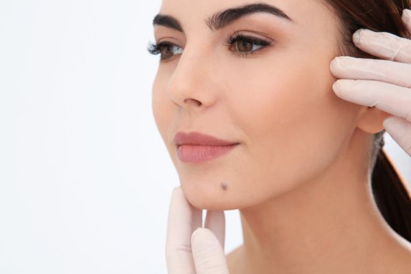 Facial Mole