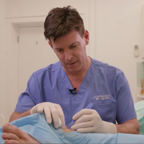 Foot mole removal surgery