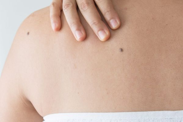 Moles Body