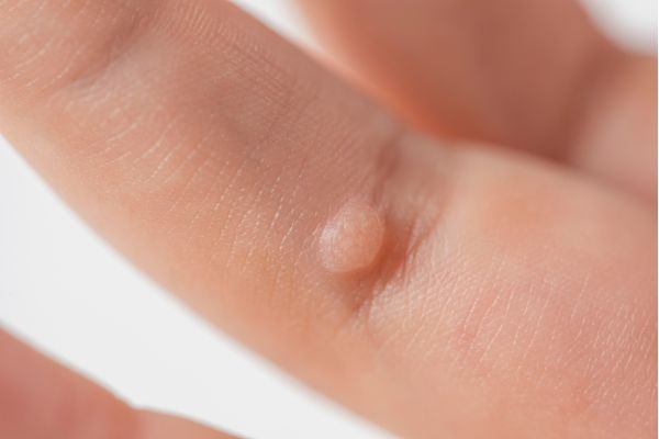 Warts