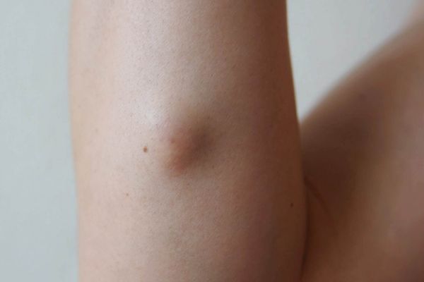 Cyst removal treatment