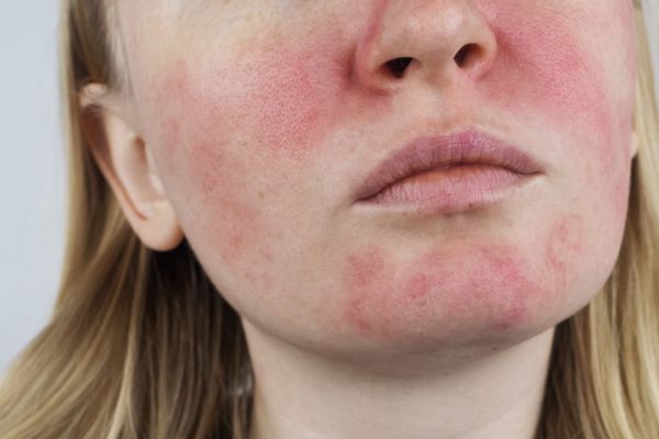 Rosacea and Redness