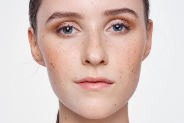 Pigmentation